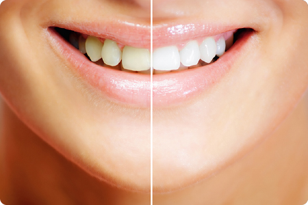 大垣市静里町・かさはら歯科クリニック・ホワイトニング